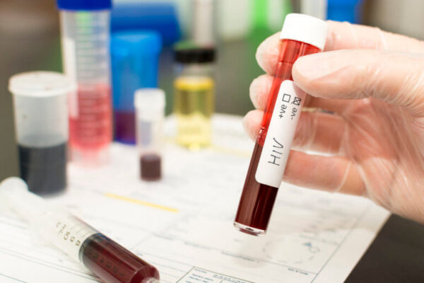 HIV